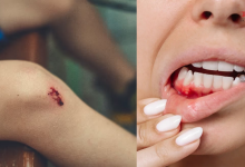 Photo of मसूड़ों से खून और नीले निशान को न करें नजरंदाज, शरीर में विटामिन K की कमी का है संकेत