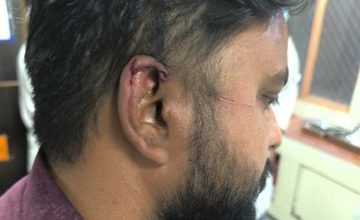 Photo of खतरनाक मांझे ने फिर लिया निशाना: नगर निगम कर्मचारी घायल, आंख बची