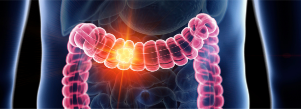 कोलन कैंसर