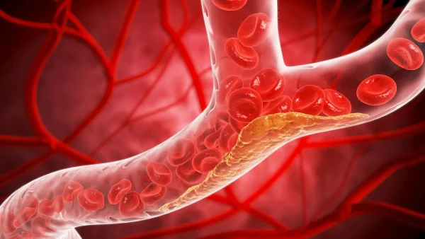 Bad Cholesterol