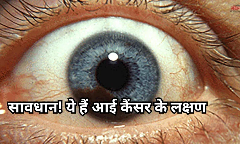 eye cancer