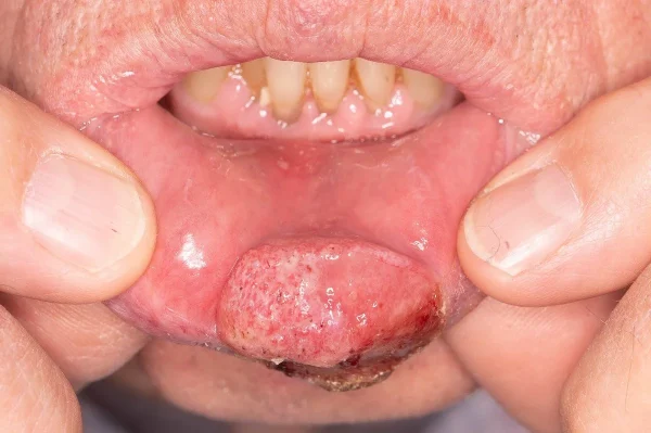 oral cancer