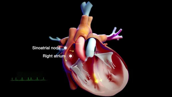 Atrial Fibrillation