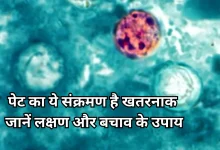 Photo of साइक्लोस्पोरा इन्फेक्शन: जानें क्या है यह बीमारी, कैसे फैलती है और कैसे करें बचाव