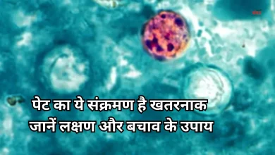Photo of साइक्लोस्पोरा इन्फेक्शन: जानें क्या है यह बीमारी, कैसे फैलती है और कैसे करें बचाव
