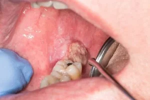 Ultrasound can be used to treat oral cancer