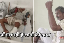 Photo of बैक्टीरियल संक्रमण का कहर, जरा सी इस चोट पर गलने लग रही त्वचा