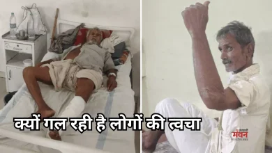 Photo of बैक्टीरियल संक्रमण का कहर, जरा सी इस चोट पर गलने लग रही त्वचा