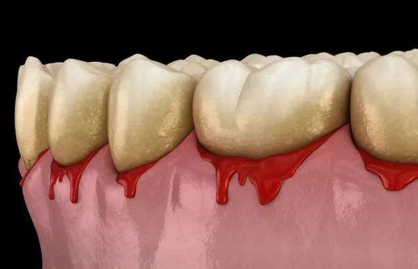 Bleeding gums are a warning sign