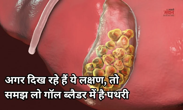 Gallbladder Stones: