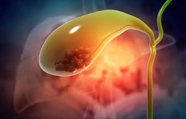 Gallbladder Stones