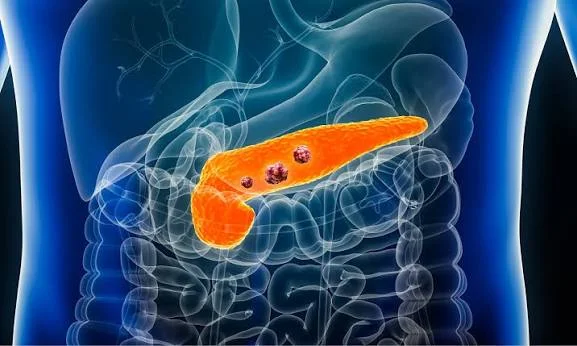 Pancreatic Cancer