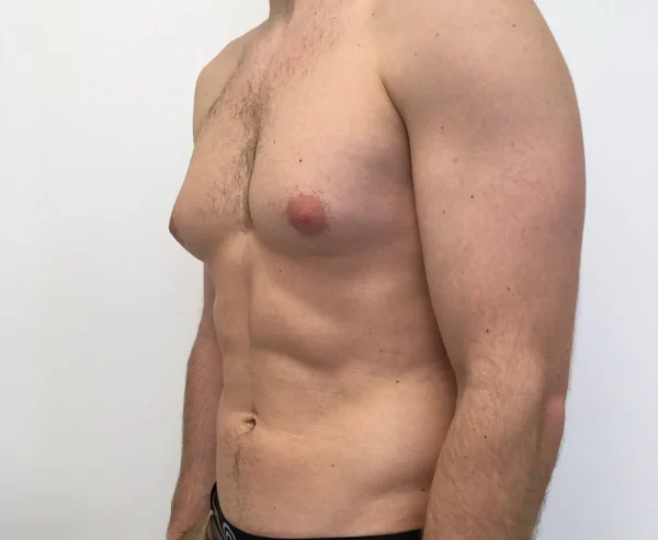Steroid side effects