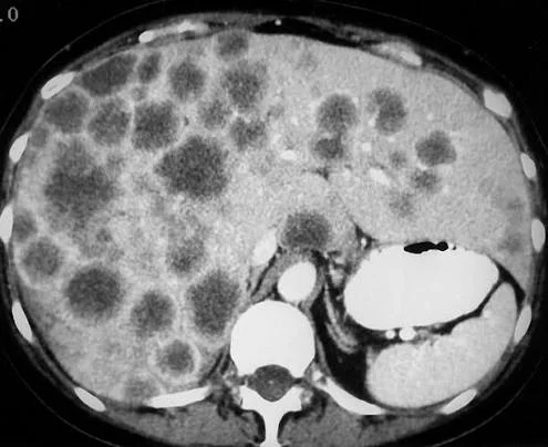 Colon Cancer