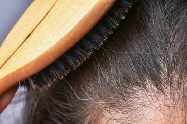 Stress and hair fall