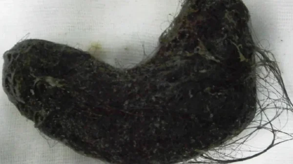 Trichobezoar