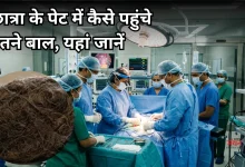 Photo of छात्रा के पेट से निकला 1.16 किलो का बालों का गुच्छा, डॉक्टर भी हुए हैरान