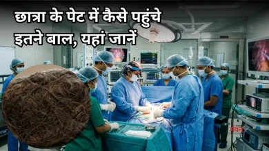 Photo of छात्रा के पेट से निकला 1.16 किलो का बालों का गुच्छा, डॉक्टर भी हुए हैरान