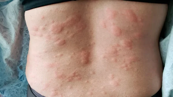 Itching and Rashes