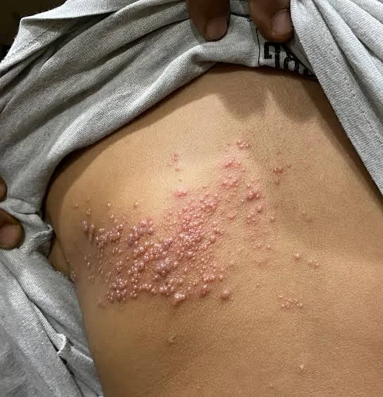 Shingles