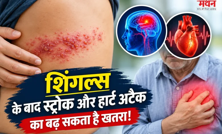 Shingles