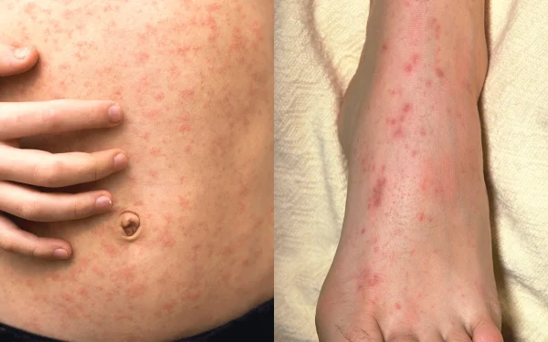 itching and rashes